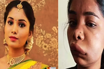 Pictures of Kannada actress Swathi Sathish go viral after her root canal surgery goes wrong